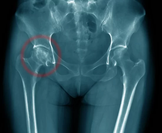 Radiografia evidenciando osteonecrose avançada (grau 4) - imagem circulada de vermelho.